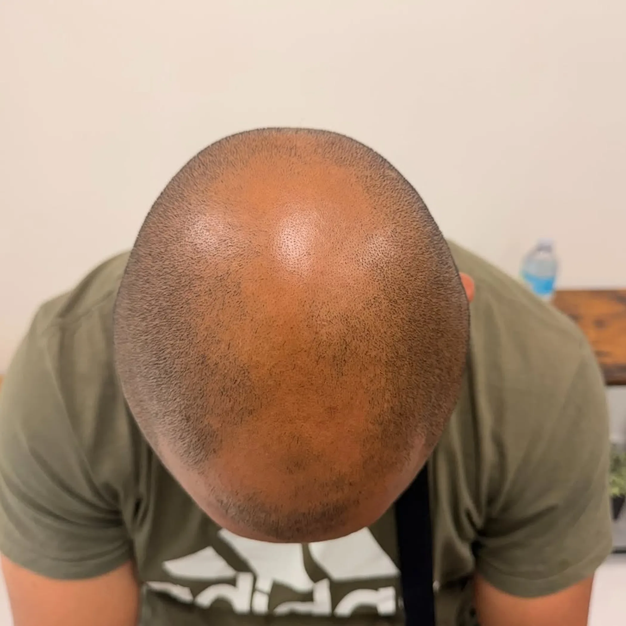 scalp micropigmentation on thinning hair