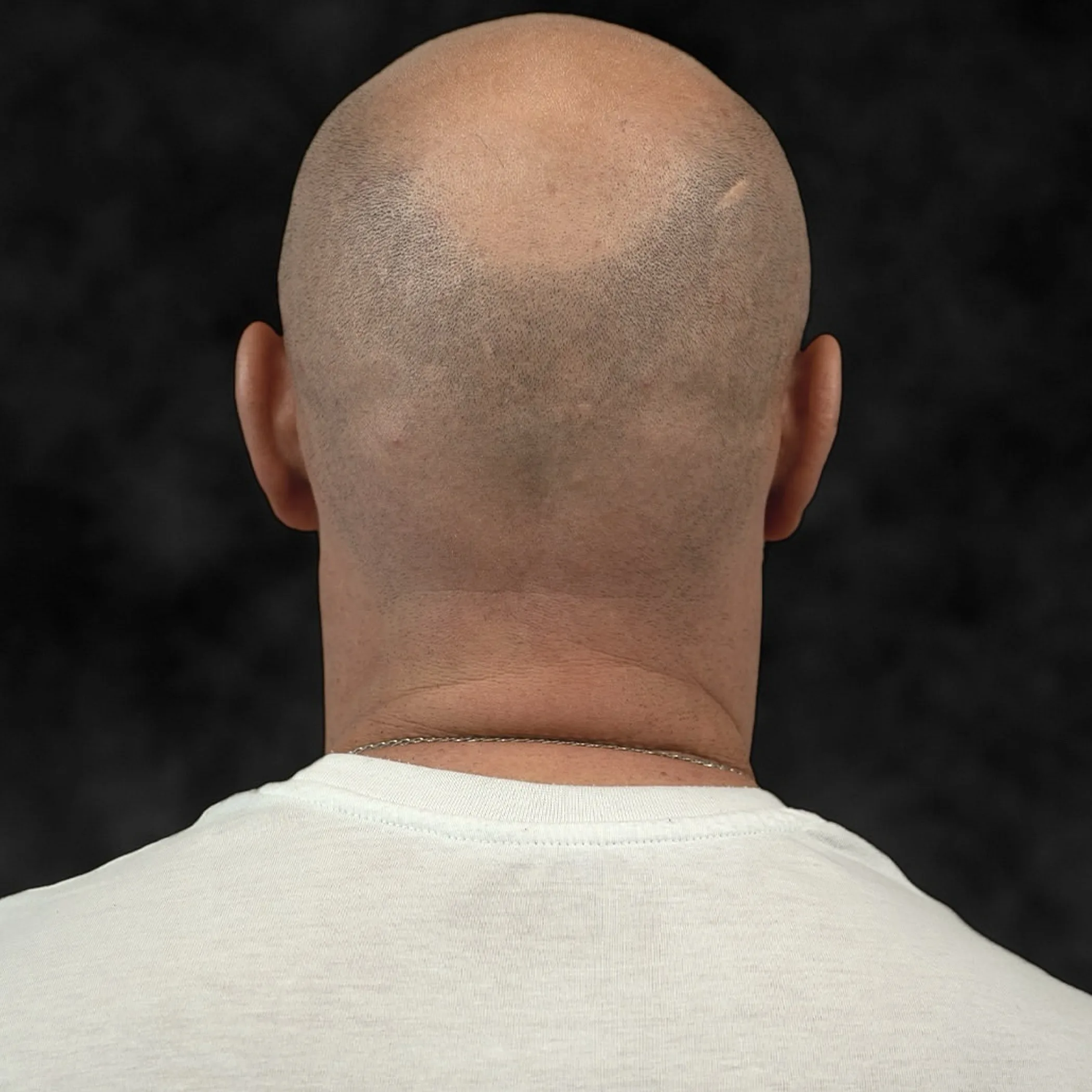 scalp micropigmentation close-up on scalp