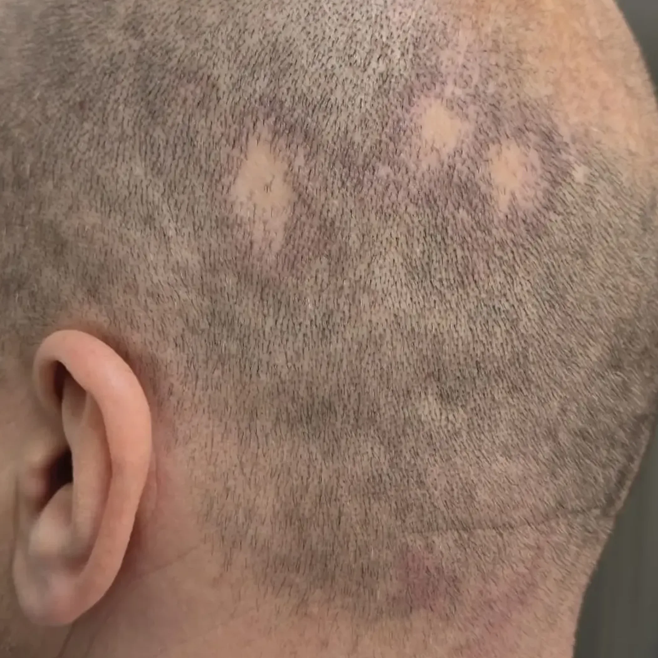 scalp micropigmentation on alopecia scalp