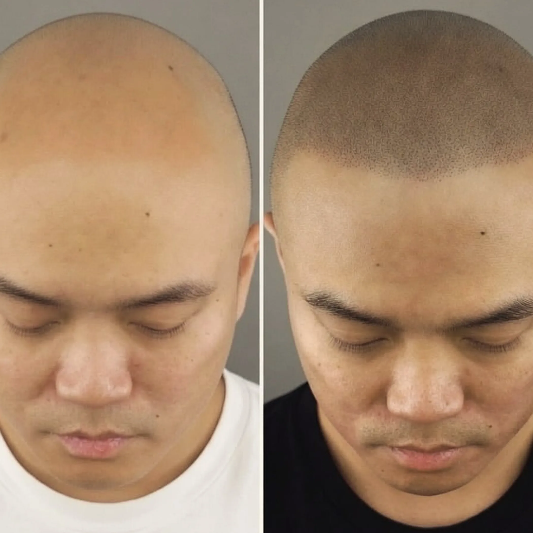 scalp micropigmentation results on scalp